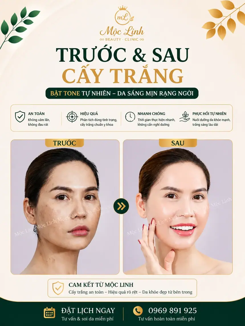 Cấy trắng da tại Thẩm Mỹ Mộc Linh Hải Phòng - hình 3