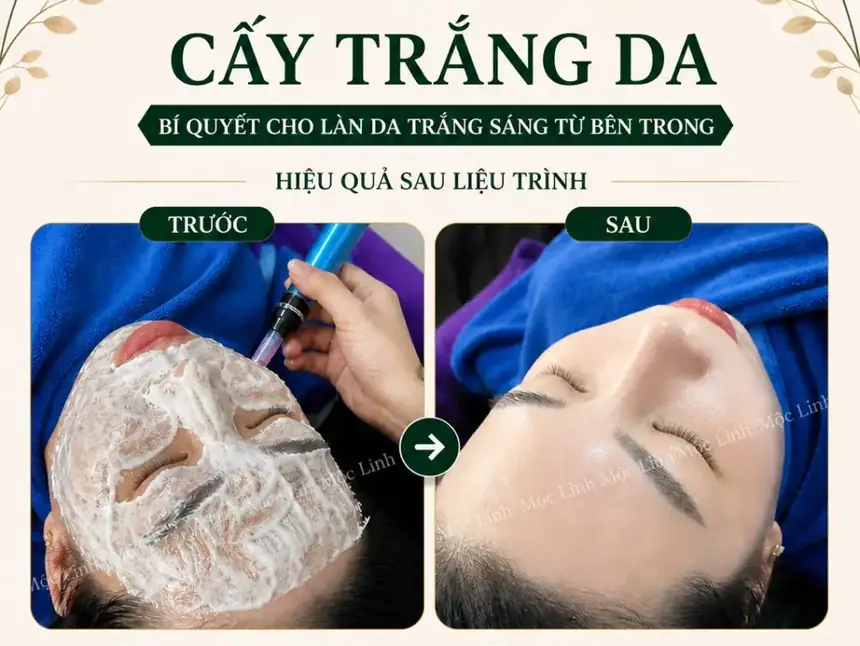 Cấy trắng da tại Thẩm Mỹ Mộc Linh Hải Phòng - hình 6