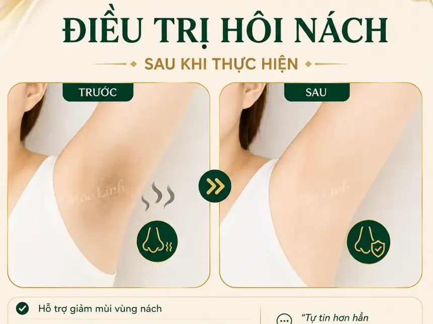 Trị hôi nách Hải Phòng tại Thẩm Mỹ Mộc Linh - hình 11