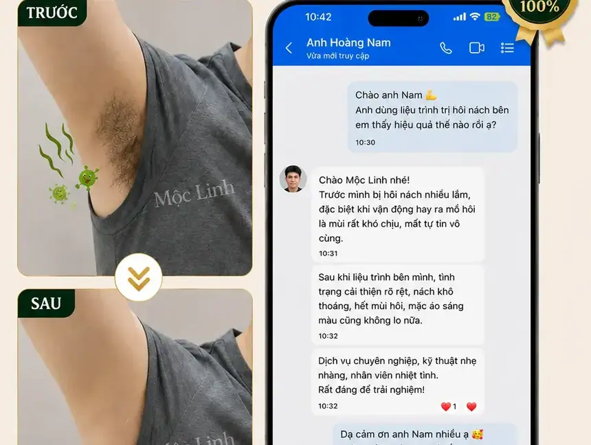 Trị hôi nách Hải Phòng tại Thẩm Mỹ Mộc Linh - hình 2