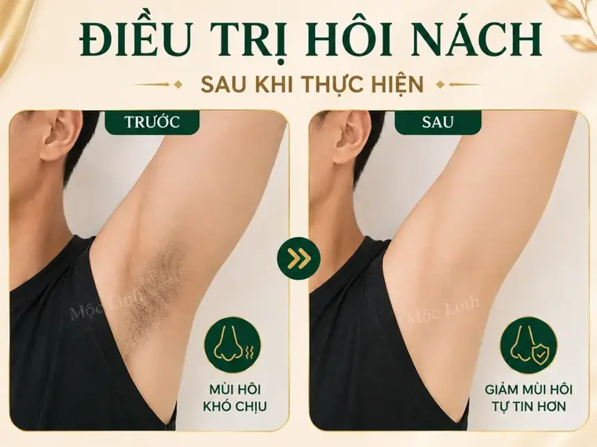 Trị hôi nách Hải Phòng tại Thẩm Mỹ Mộc Linh - hình 8