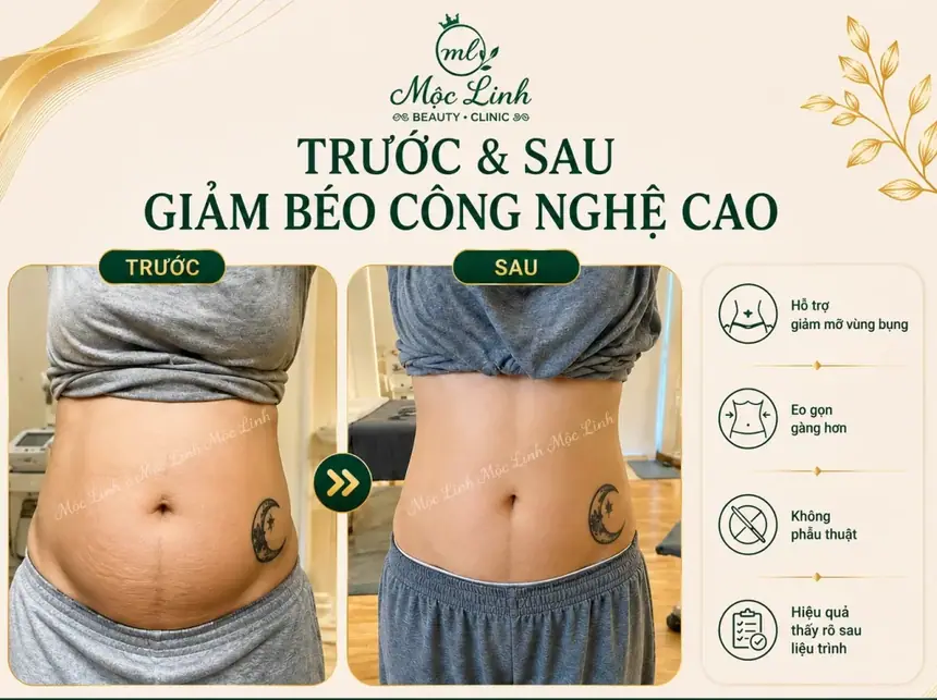Giảm Béo An Toàn Hải Phòng tại Thẩm Mỹ Mộc Linh - hình 4