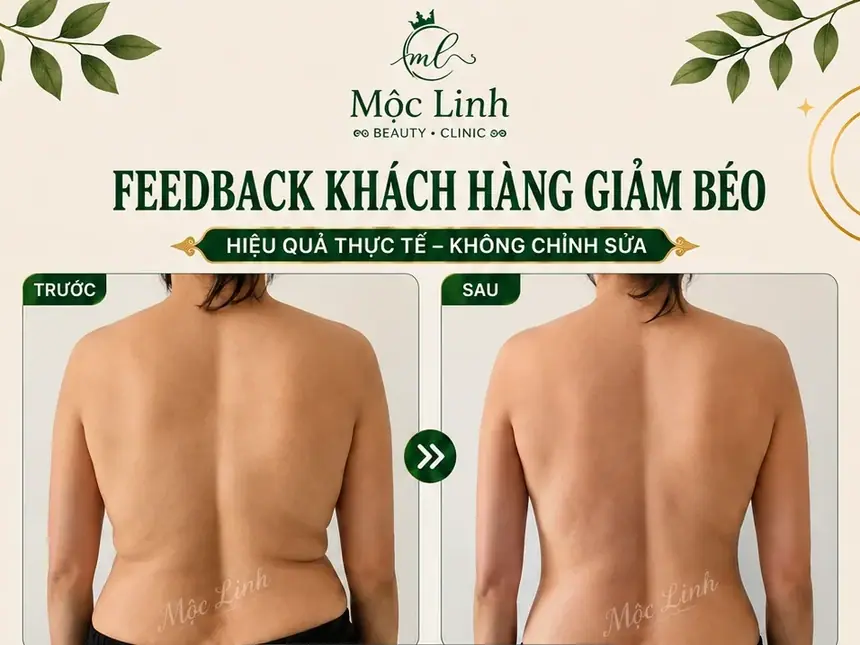 Giảm Béo An Toàn Hải Phòng tại Thẩm Mỹ Mộc Linh - hình 1