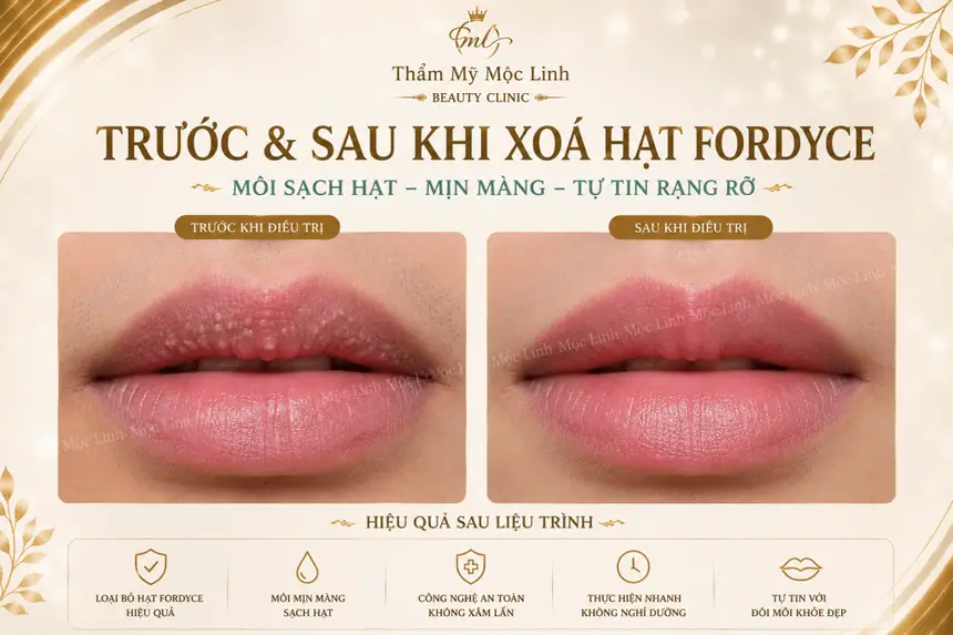 Xoá hạt Fordyce Hải Phòng tại Thẩm Mỹ Mộc Linh - hình 9