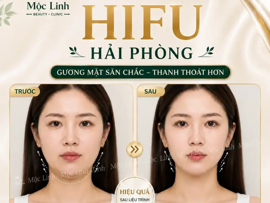 Nâng cơ công nghệ Hifu hiện đại bậc nhất tại Thẩm Mỹ Mộc Linh Hải Phòng - hình 20