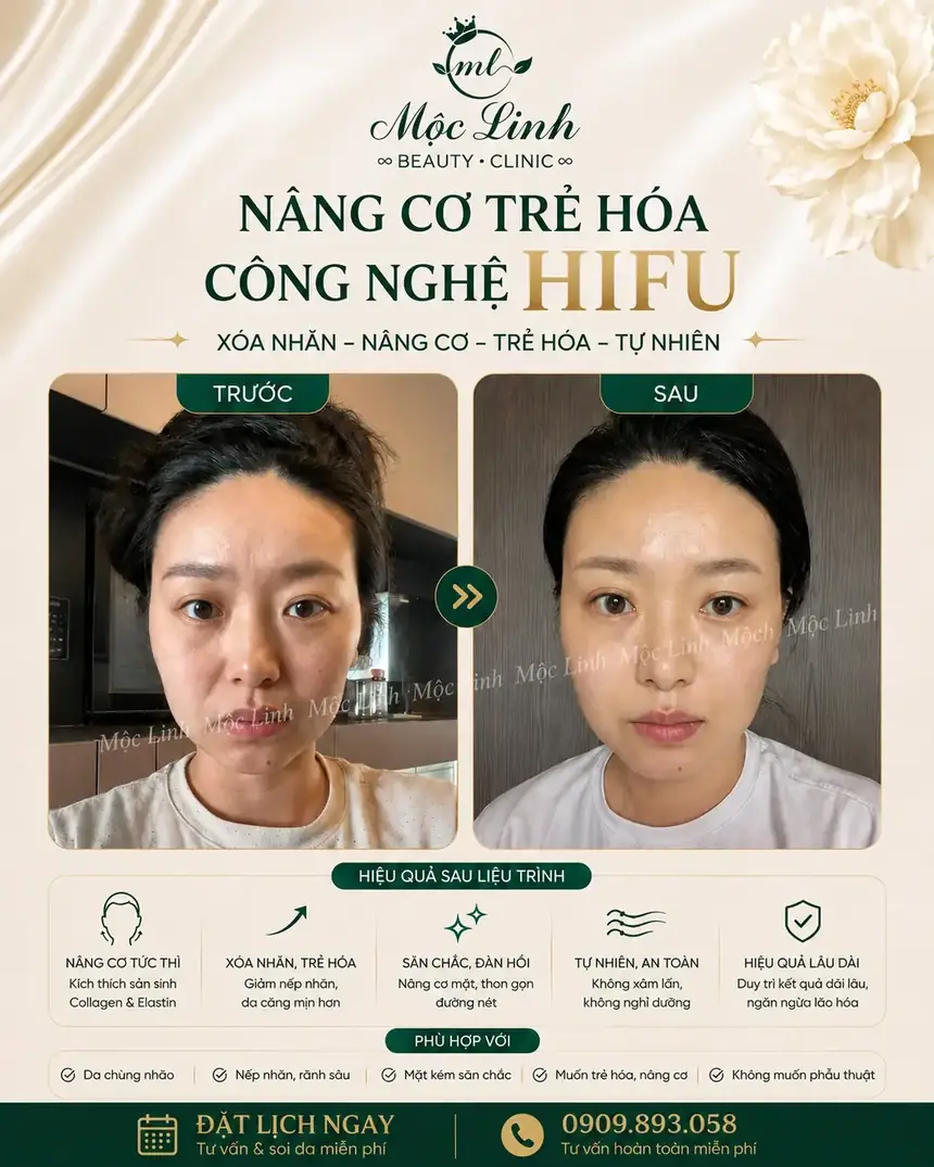 Nâng cơ công nghệ Hifu hiện đại bậc nhất tại Thẩm Mỹ Mộc Linh Hải Phòng - hình 3