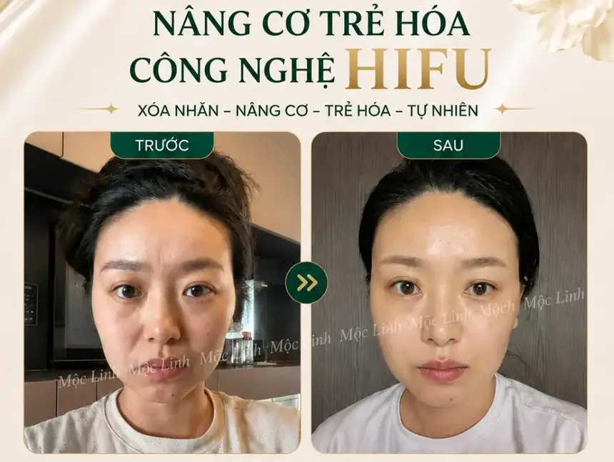 Nâng cơ công nghệ Hifu hiện đại bậc nhất tại Thẩm Mỹ Mộc Linh Hải Phòng - hình 18