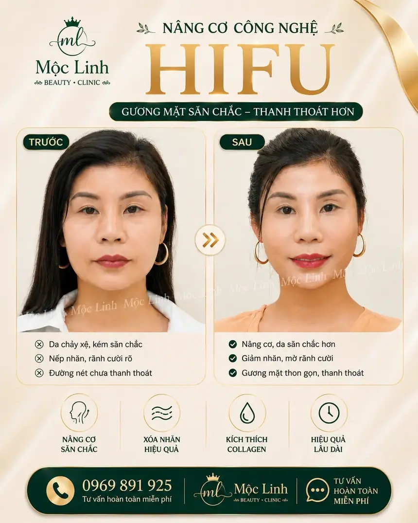 Nâng cơ công nghệ Hifu hiện đại bậc nhất tại Thẩm Mỹ Mộc Linh Hải Phòng - hình 6