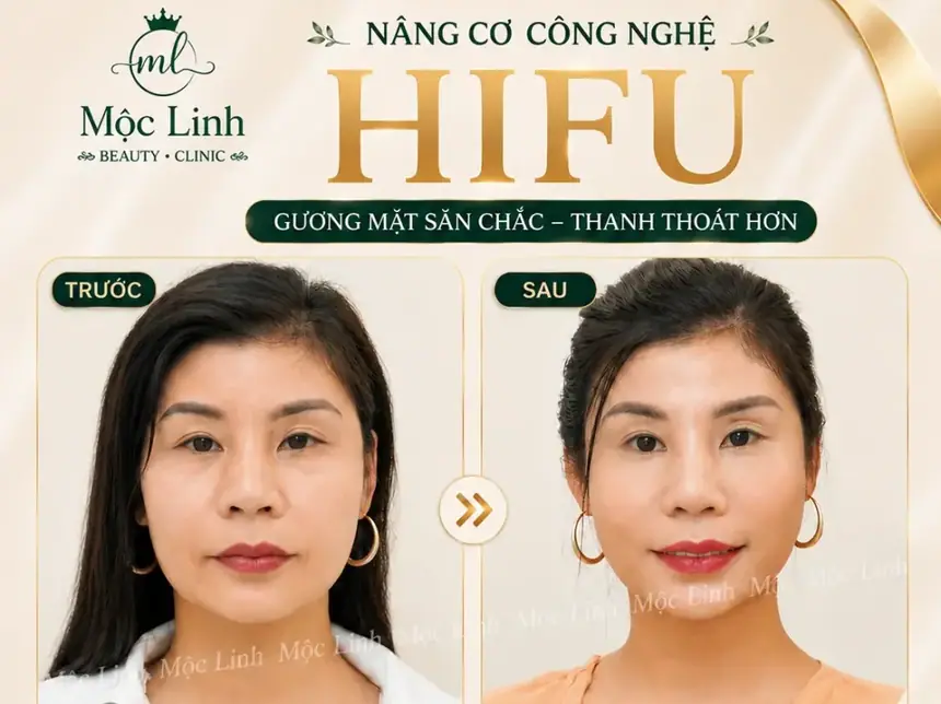 Nâng cơ công nghệ Hifu hiện đại bậc nhất tại Thẩm Mỹ Mộc Linh Hải Phòng - hình 17