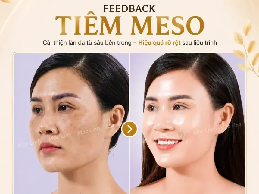 Tiêm Meso Máy An Toàn Uy Tín Hải Phòng tại Thẩm Mỹ Mộc Linh - hình 10