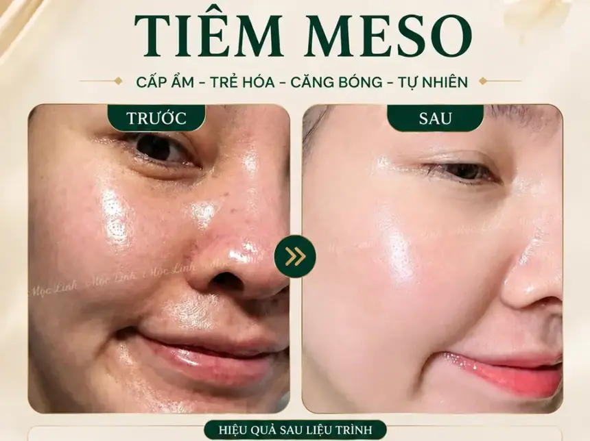 Tiêm Meso Máy An Toàn Uy Tín Hải Phòng tại Thẩm Mỹ Mộc Linh - hình 8