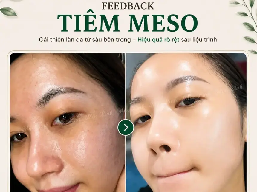 Tiêm Meso Máy An Toàn Uy Tín Hải Phòng tại Thẩm Mỹ Mộc Linh - hình 9