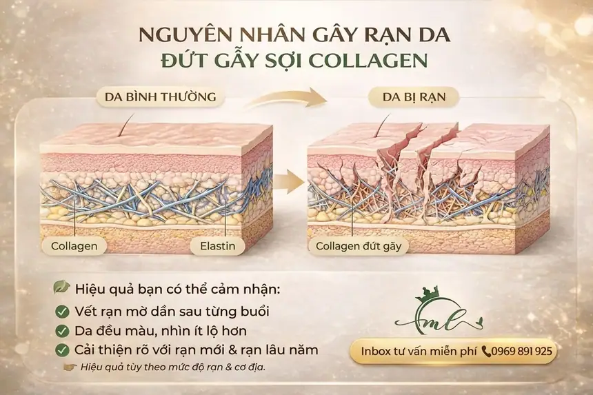 Chữa rạn da tại Thẩm Mỹ Mộc Linh Hải Phòng - hình 2