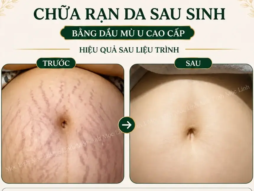 Chữa rạn da tại Thẩm Mỹ Mộc Linh Hải Phòng - hình 2