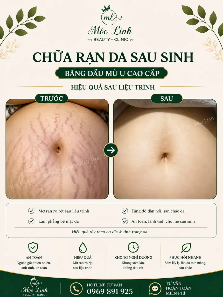 Chữa rạn da tại Thẩm Mỹ Mộc Linh Hải Phòng - hình 5