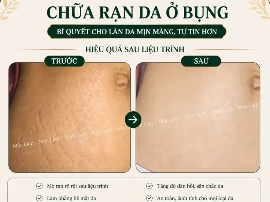 Chữa rạn da tại Thẩm Mỹ Mộc Linh Hải Phòng