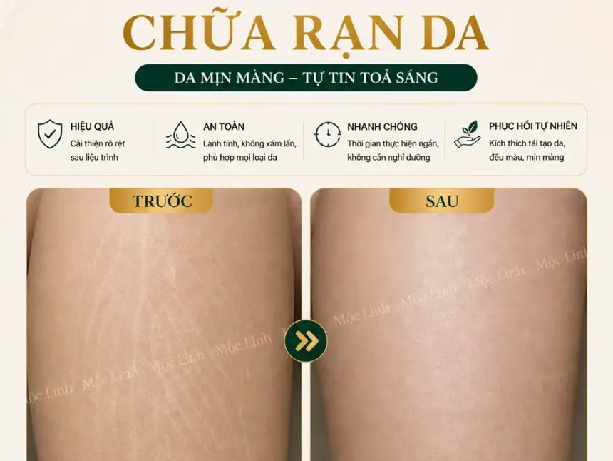 Chữa rạn da tại Thẩm Mỹ Mộc Linh Hải Phòng - hình 6