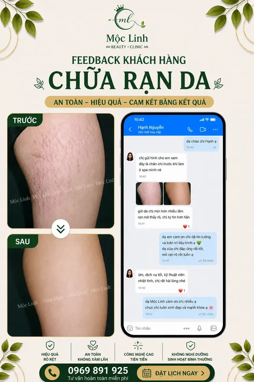 Chữa rạn da tại Thẩm Mỹ Mộc Linh Hải Phòng - hình 7