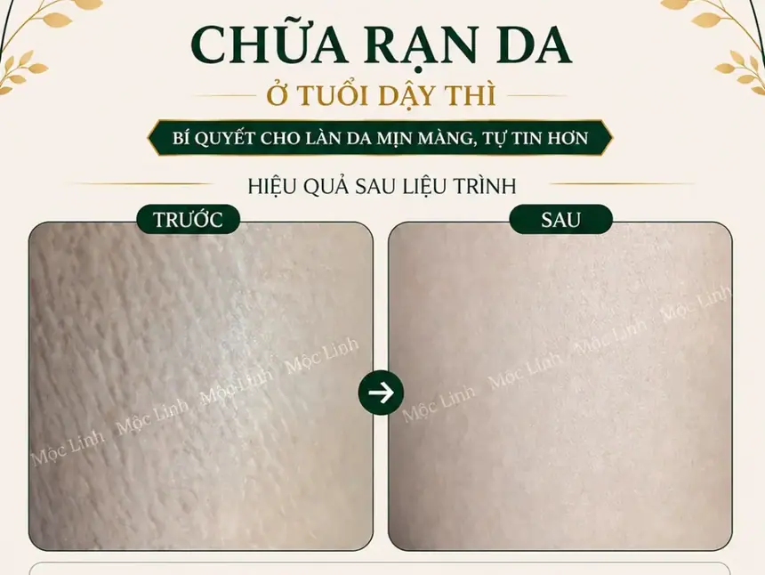 Chữa rạn da tại Thẩm Mỹ Mộc Linh Hải Phòng - hình 4