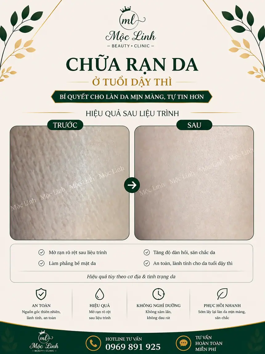 Chữa rạn da tại Thẩm Mỹ Mộc Linh Hải Phòng - hình 4