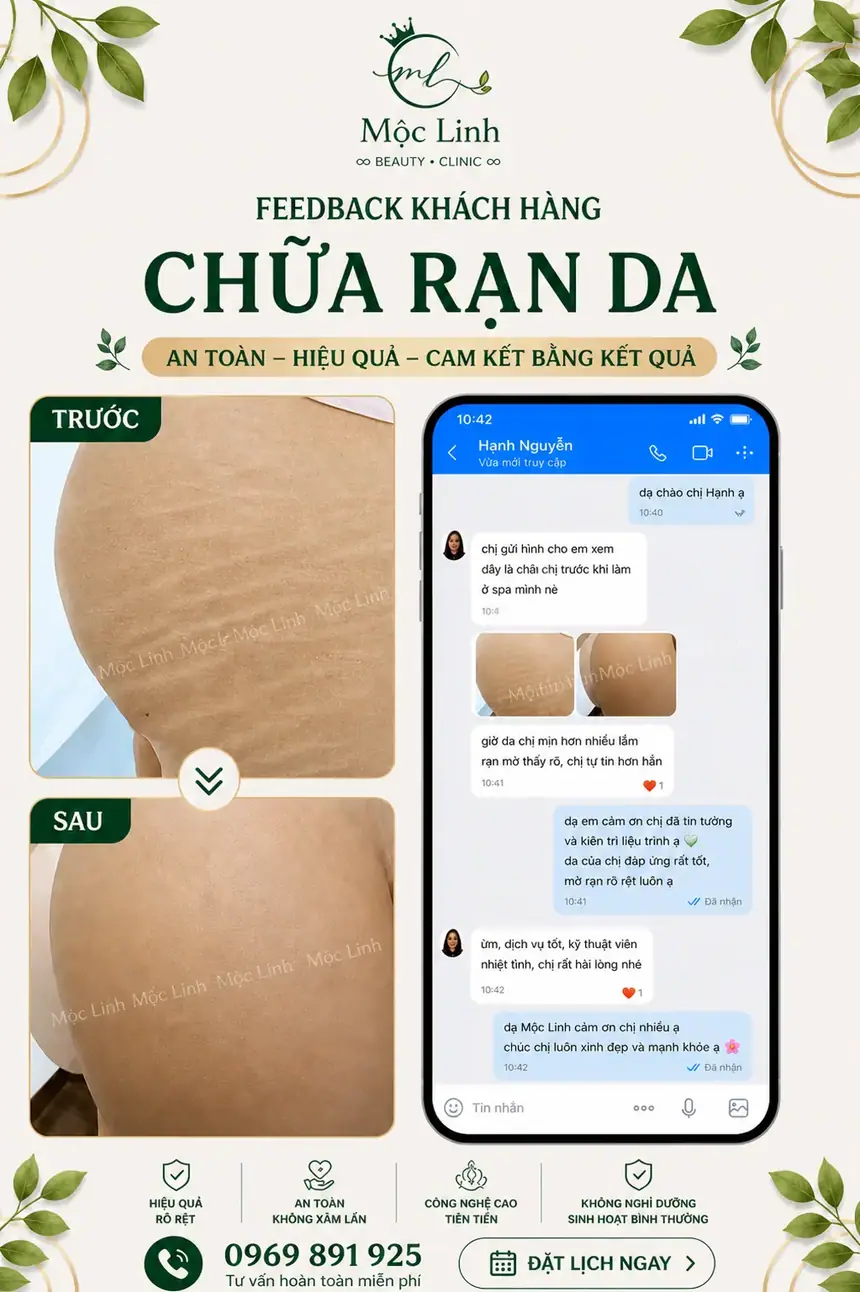 Chữa rạn da tại Thẩm Mỹ Mộc Linh Hải Phòng - hình 6