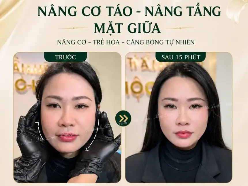 Nâng cơ táo (Căng chỉ) uy tín tại Hải Phòng tại Thẩm Mỹ Mộc Linh - hình 6