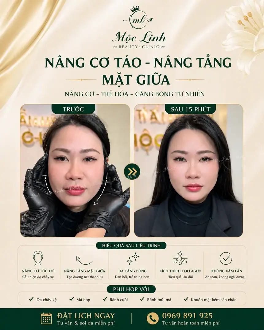 Nâng cơ táo (Căng chỉ) uy tín tại Hải Phòng tại Thẩm Mỹ Mộc Linh - hình 4