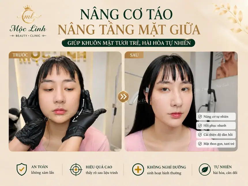 Nâng cơ táo (Căng chỉ) uy tín tại Hải Phòng tại Thẩm Mỹ Mộc Linh - hình 3