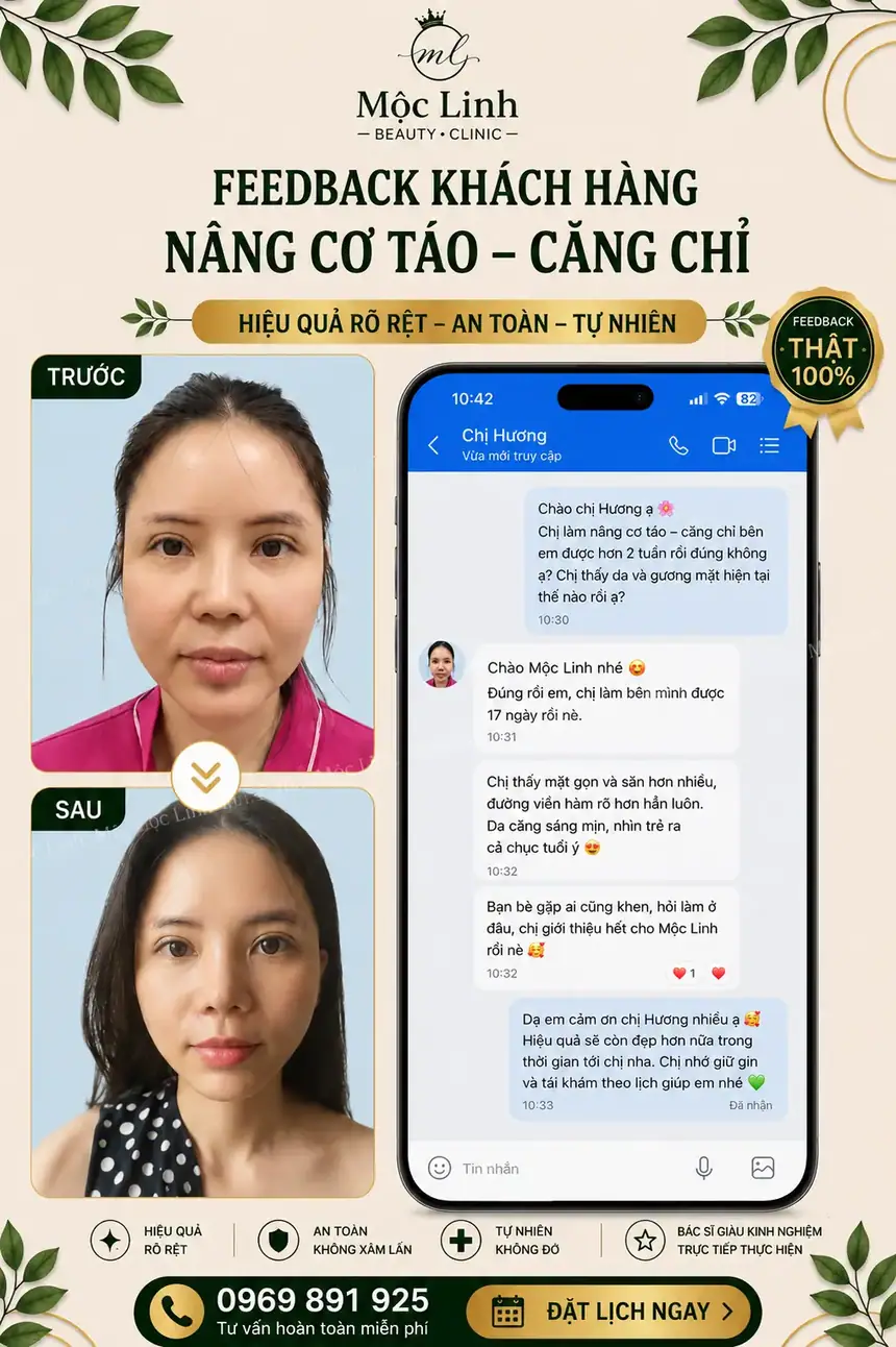 Nâng cơ táo (Căng chỉ) uy tín tại Hải Phòng tại Thẩm Mỹ Mộc Linh - hình 6