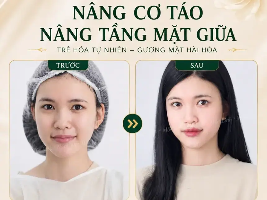 Nâng cơ táo (Căng chỉ) uy tín tại Hải Phòng tại Thẩm Mỹ Mộc Linh - hình 2