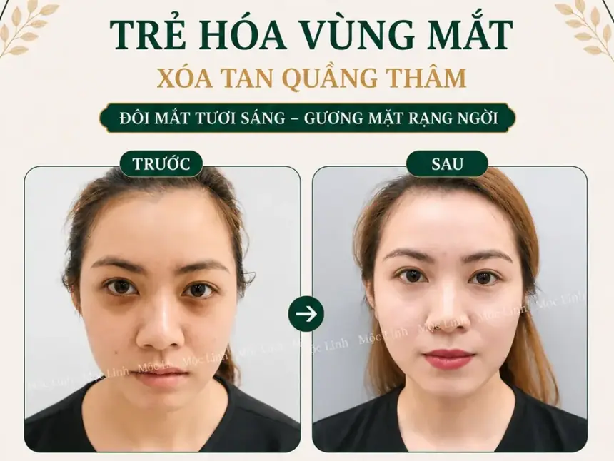 Chữa thâm mắt uy tín Hải Phòng tại Thẩm Mỹ Mộc Linh - hình 8