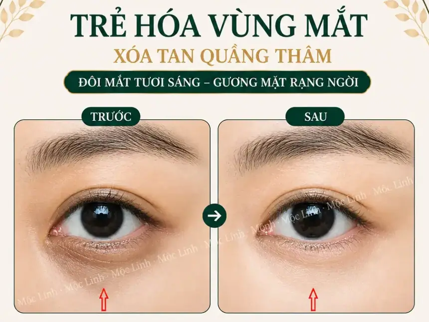 Chữa thâm mắt uy tín Hải Phòng tại Thẩm Mỹ Mộc Linh - hình 6