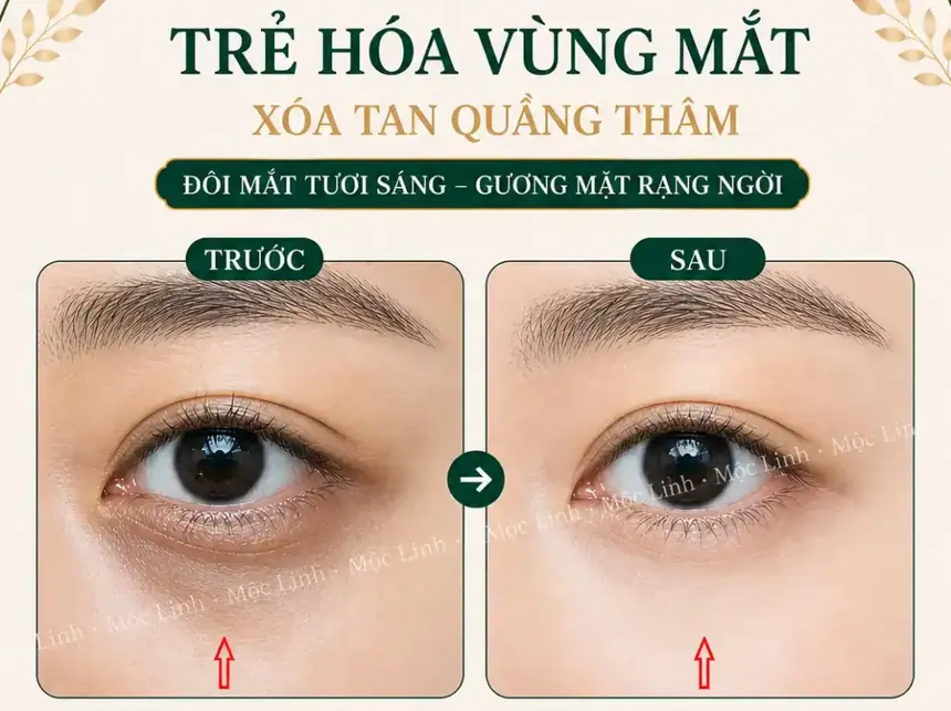 Chữa thâm mắt uy tín Hải Phòng tại Thẩm Mỹ Mộc Linh - hình 4