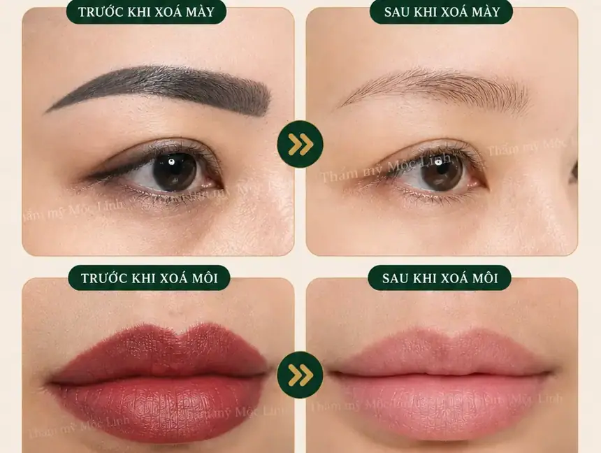 Xoá xăm mày - môi Hải Phòng tại Thẩm Mỹ Mộc Linh - hình 1