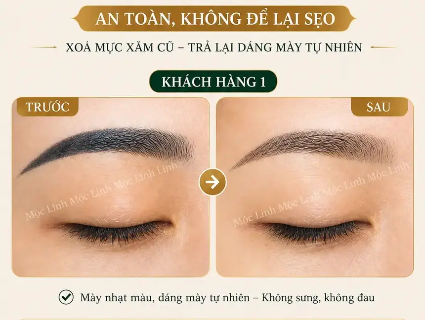Xoá xăm mày - môi Hải Phòng tại Thẩm Mỹ Mộc Linh - hình 2
