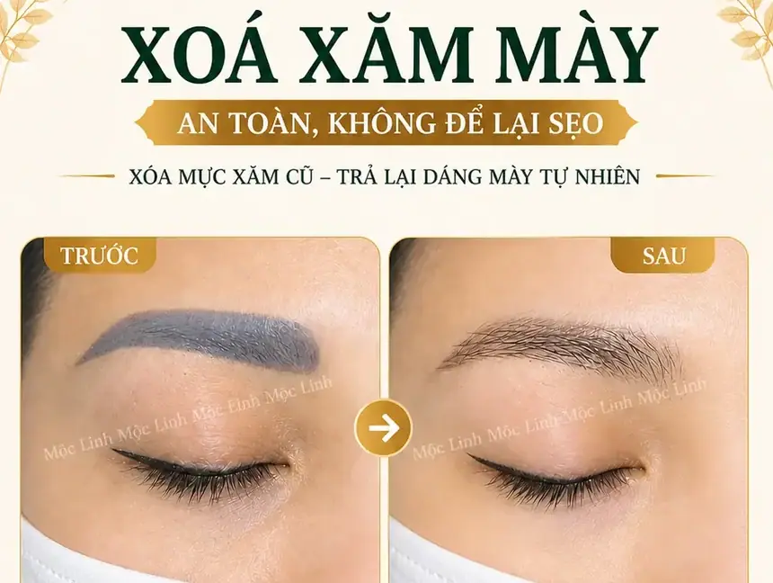 Xoá xăm mày - môi Hải Phòng tại Thẩm Mỹ Mộc Linh - hình 3