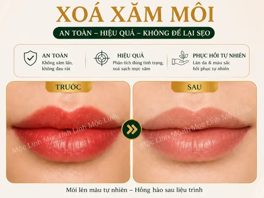 Xoá xăm mày - môi Hải Phòng tại Thẩm Mỹ Mộc Linh - hình 6