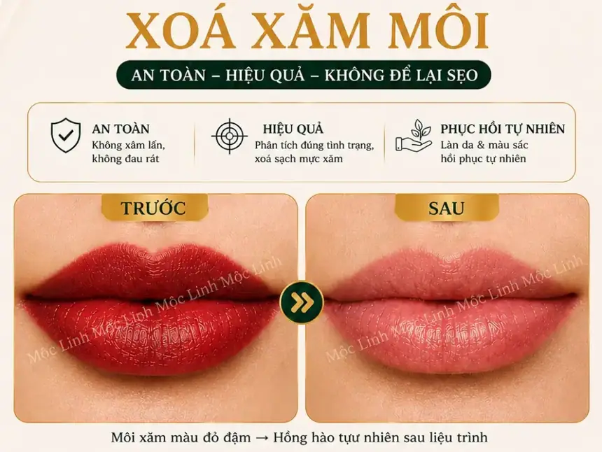 Xoá xăm mày - môi Hải Phòng tại Thẩm Mỹ Mộc Linh - hình 4