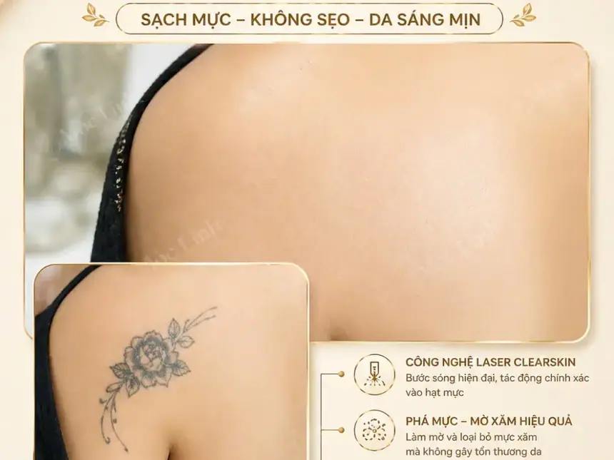 Xoá hình xăm Hải Phòng tại Thẩm Mỹ Mộc Linh - hình 10