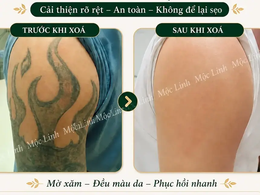 Xoá hình xăm Hải Phòng tại Thẩm Mỹ Mộc Linh - hình 6
