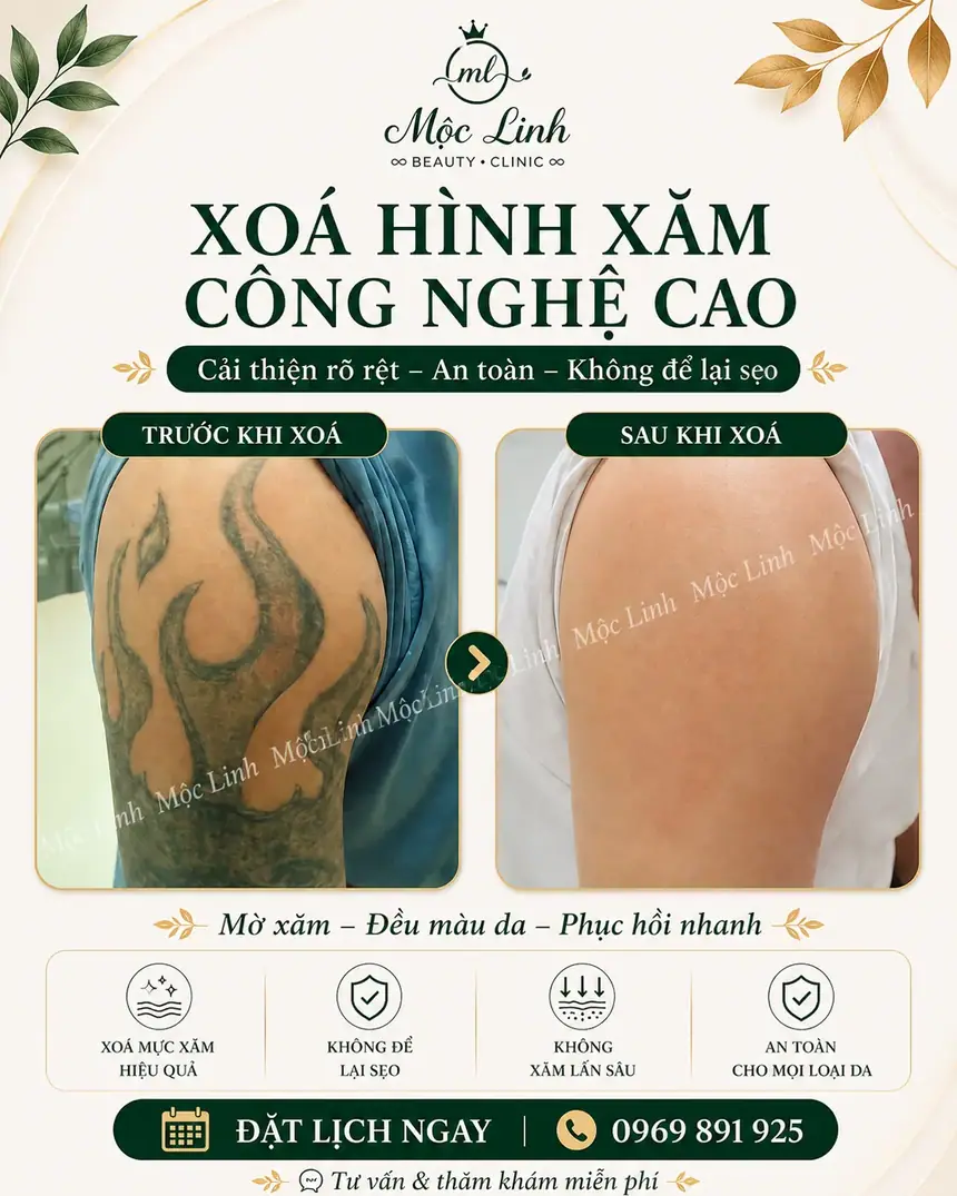 Xoá hình xăm Hải Phòng tại Thẩm Mỹ Mộc Linh - hình 5