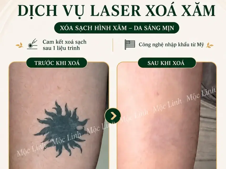 Xoá hình xăm Hải Phòng tại Thẩm Mỹ Mộc Linh - hình 13