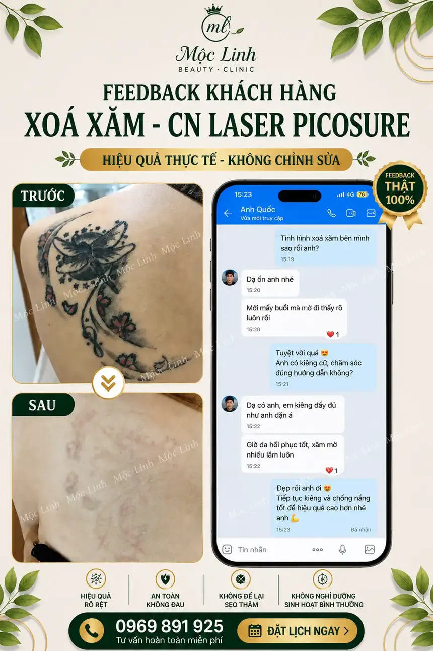 Xoá hình xăm Hải Phòng tại Thẩm Mỹ Mộc Linh - hình 7