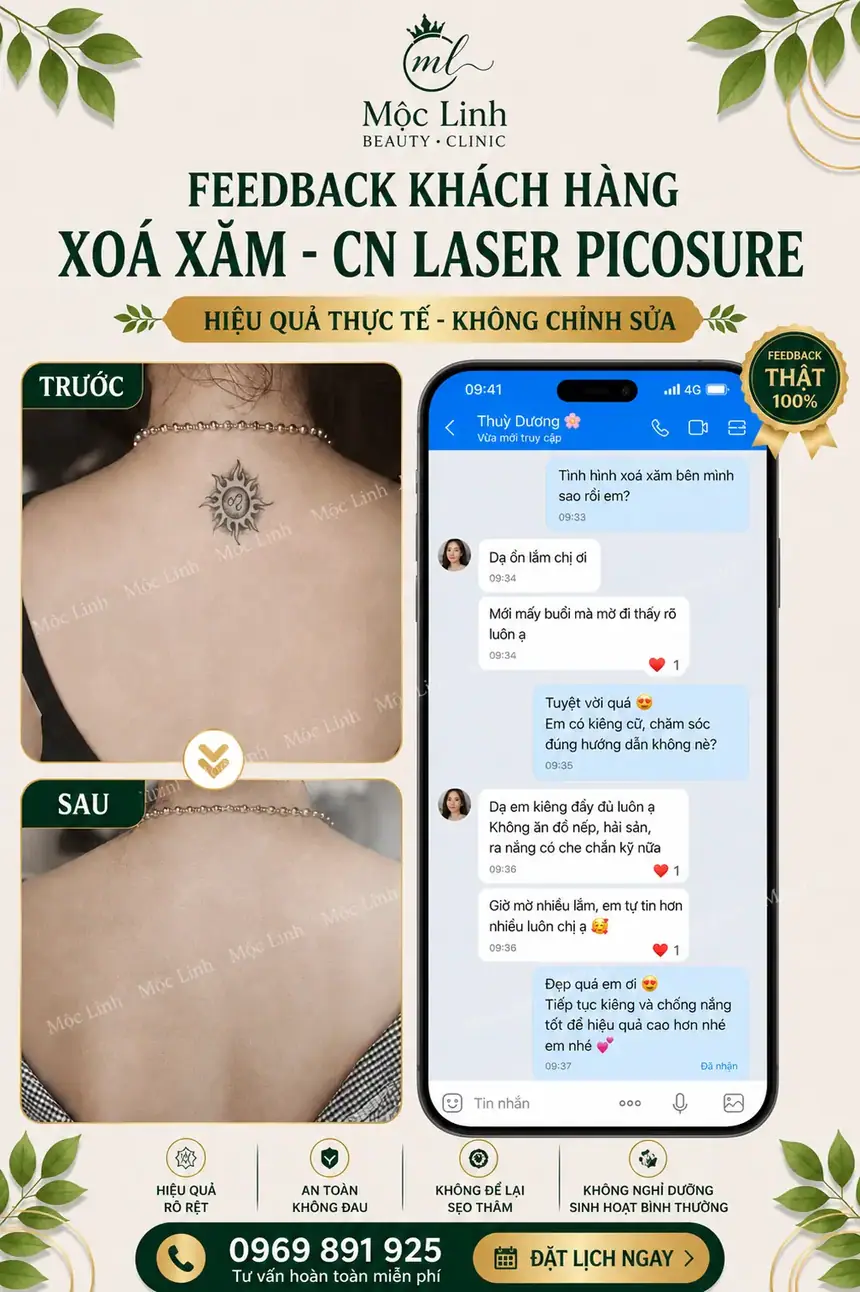 Xoá hình xăm Hải Phòng tại Thẩm Mỹ Mộc Linh - hình 8