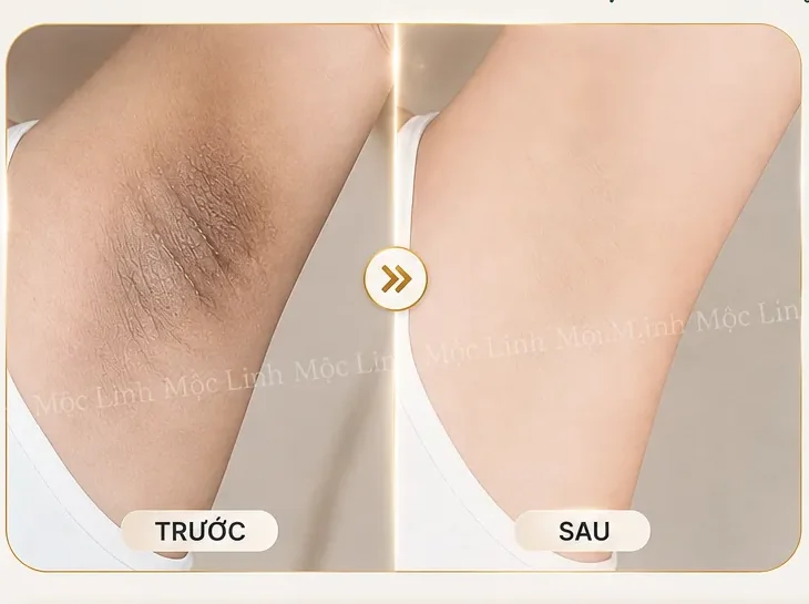 Trị thâm nách - bẹn Hải Phòng tại Thẩm Mỹ Mộc Linh - hình 6
