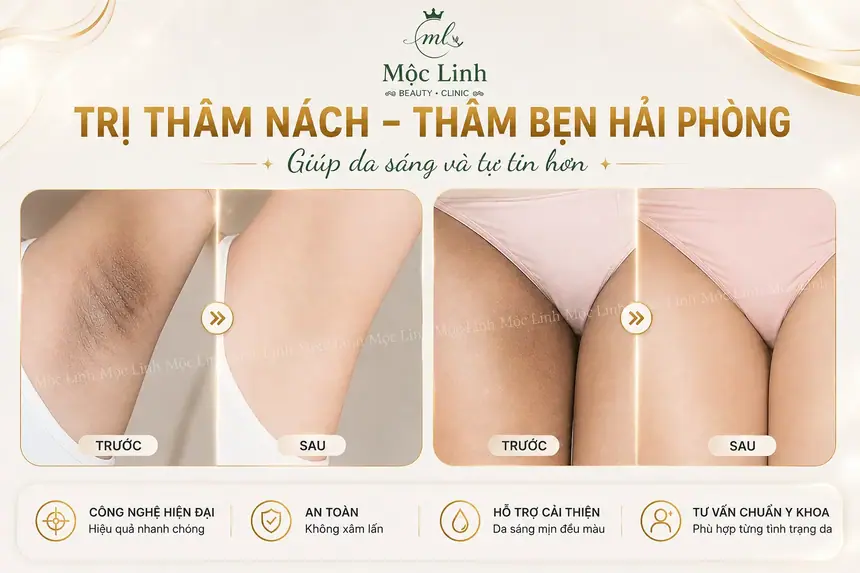 Trị thâm nách - bẹn Hải Phòng tại Thẩm Mỹ Mộc Linh - hình 1