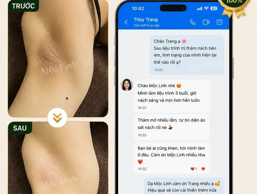 Trị thâm nách - bẹn Hải Phòng tại Thẩm Mỹ Mộc Linh - hình 2