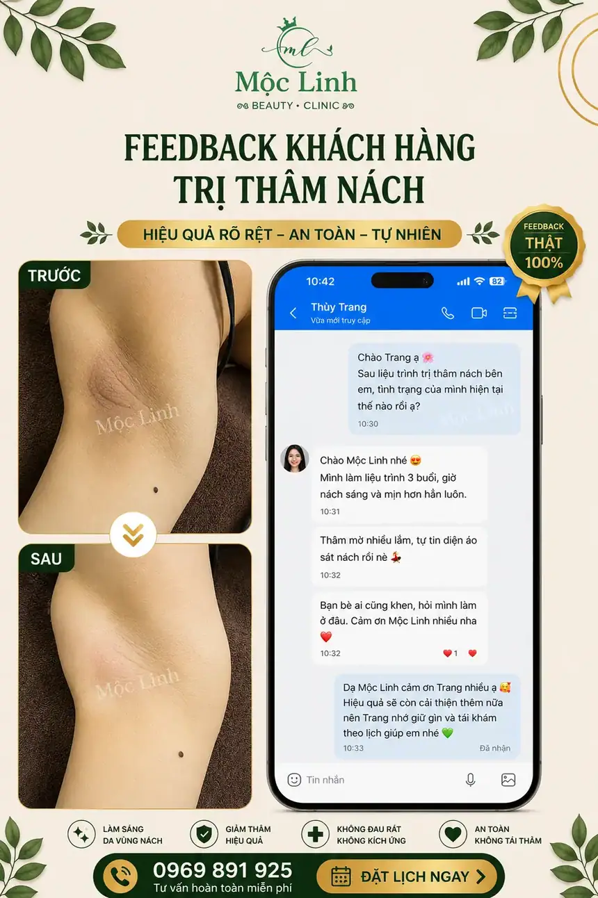 Trị thâm nách - bẹn Hải Phòng tại Thẩm Mỹ Mộc Linh - hình 5