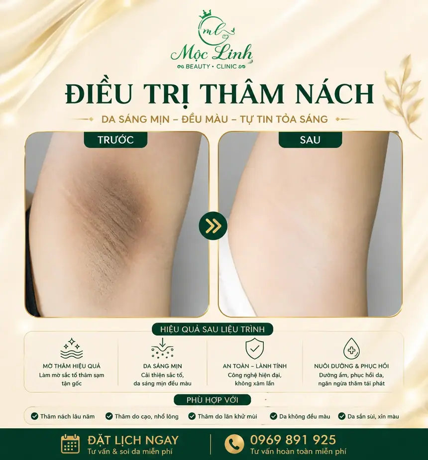 Trị thâm nách - bẹn Hải Phòng tại Thẩm Mỹ Mộc Linh - hình 2