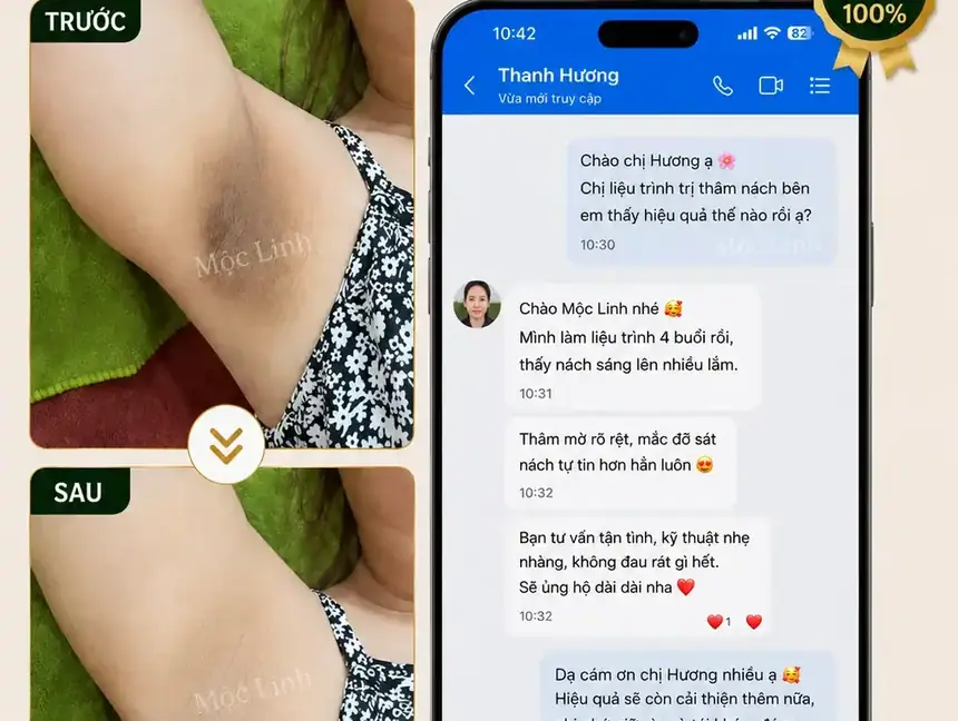 Trị thâm nách - bẹn Hải Phòng tại Thẩm Mỹ Mộc Linh - hình 1